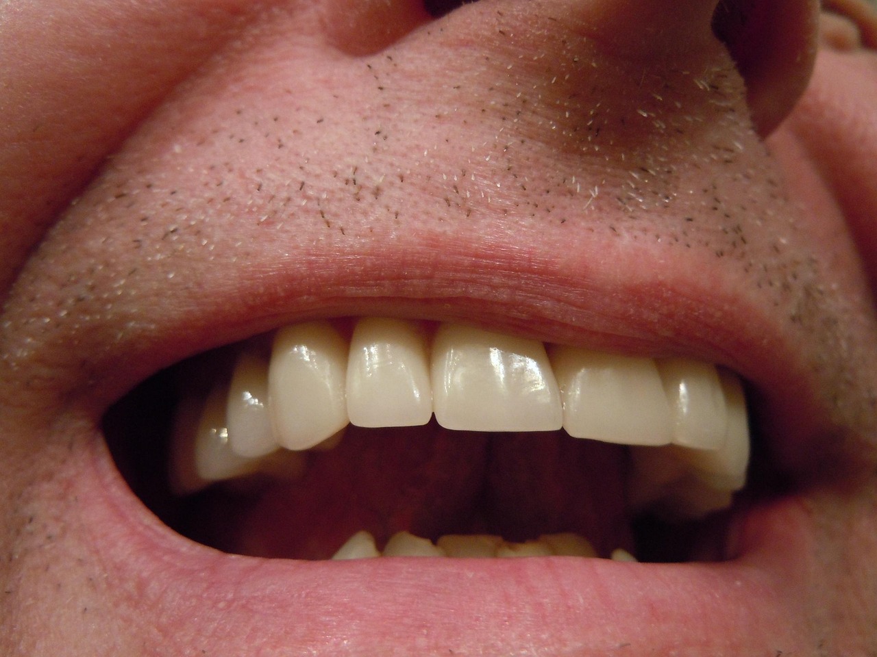 Transform Your Smile: Coral Springs Dental Veneers Guide
